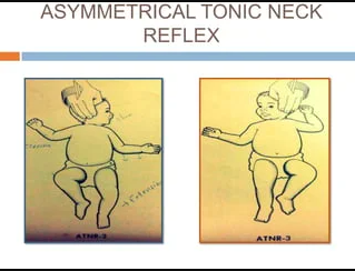 ATNR (Asymmetrical Tonic Neck Reflex)