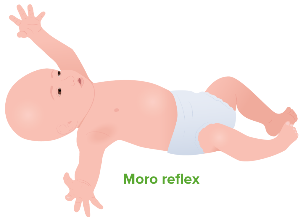 Moro Reflex