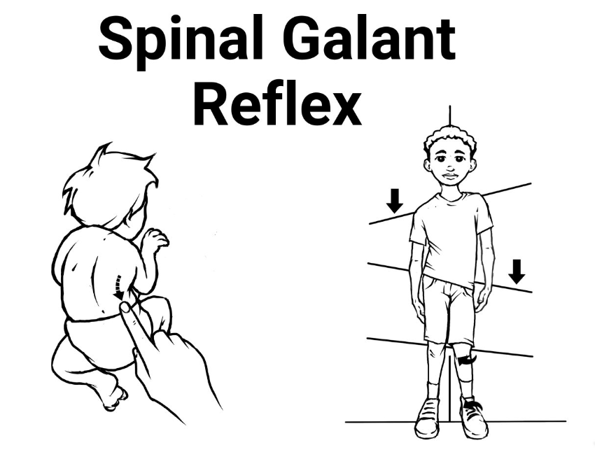 Spinal Galant Reflex